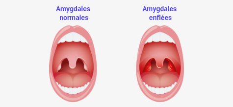 Schéma des amygdales
