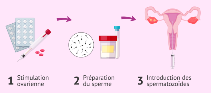 L'INSÉMINATION ARTIFICIELLE